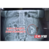 娭毑患结石仅吃药止痛 拖延二十年结石狂增数倍险些塞满左肾