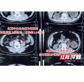 男子腰腹胀痛、畏寒发热误以为中暑 就医后才知“真凶”是结石