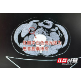 男子腹胀腹痛吃胃药自治数月 症状加剧就医才知是结石作妖