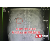 每天至少喝4斤浓茶提神 男子肾脏竟长出爱心状大结石