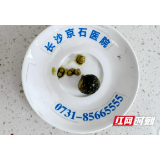 女子查出“沉默结石”不以为然 今结石大如鹌鹑蛋惊险保胆