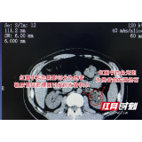 男子腰痛、排尿不畅查出结石 不愿手术拖延两月致输尿管被卡伤