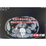 女子高烧39度伴腹痛以为是流感 就医发现“真凶”竟是结石