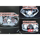 女子查出肾结石后一再忽视 今腰腹出现硬块就医才知酿成大祸