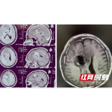 湖南省肿瘤医院：重塑脑肿瘤患者的生活