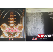 男子小便刺痛还带血却当上火没在意 偶然体检才知是结石在作怪