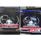 男子结石发作坚持药物治疗 拖延3月就医才知右肾功能岌岌可危
