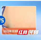40年前的结石手术是怎样的？ 患者姚大爷用手术效果告诉你