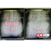 女子结石发作痛到瘫跪在地 就医一查发现肾脏陷入重重危机