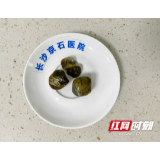 娭毑后背胀痛多年却不知是结石 如今保胆取出3大颗结石