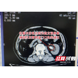 嗲嗲早年因结石切除右肾 如今左肾也陷入结石危机险患尿毒症