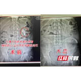 嗲嗲患结石多年一直放任不管 不想肾脏长出近6厘米“大蘑菇”