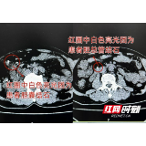 七旬老人腹痛加剧还全身发黄 背后竟是“小小结石”在作乱