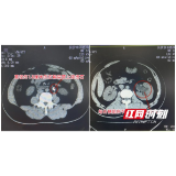 男子腰部一痛就按摩缓解 竟致结石引发肾积水还卡伤输尿管