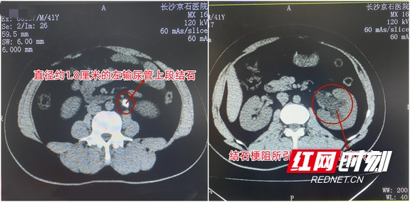 男子腰部一痛就按摩缓解 竟致结石引发肾积水还卡伤输尿管