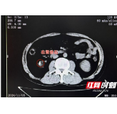 嗲嗲棋盘前一坐就是大半天 突发腰痛入院才知是结石作祟