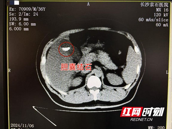 男子结石发作隐忍了事 腹痛难捱就医才知胆囊功能尽失