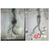 七旬老翁腹主动脉瘤破裂危在旦夕 长沙市第一医院是这么做的