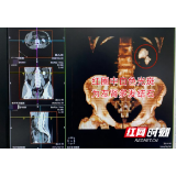 男子喝水少爱吃豆腐 肾脏竟然长“蘑菇”