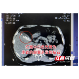 结石不痛不痒却默默疯长 嗲嗲胆囊内取出34颗“黑珍珠”