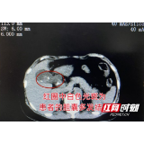 女子突发胆绞痛紧急就医，保胆取出满满一盘“核桃仁”
