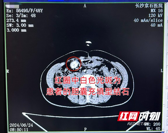 女子突发腹痛入院就医 一查竟是胆囊已被结石“塞满”