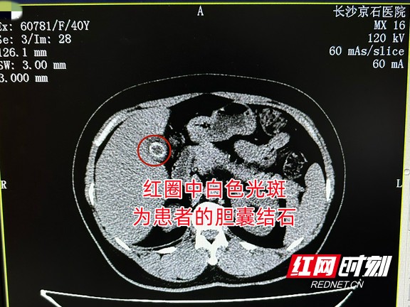 结石反复引起腹痛到寝食难安 女子保胆取出颗“橄榄石”