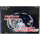 男子左肾切除右肾又长结石 长沙京石医院巧施无创手术消除隐患