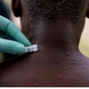 时刻知道丨类似天花、飞沫传播、人传人，猴痘是个啥病毒？