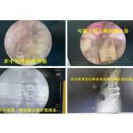 首例！湘雅常德医院骨科成功实施腰椎UBE融合手术