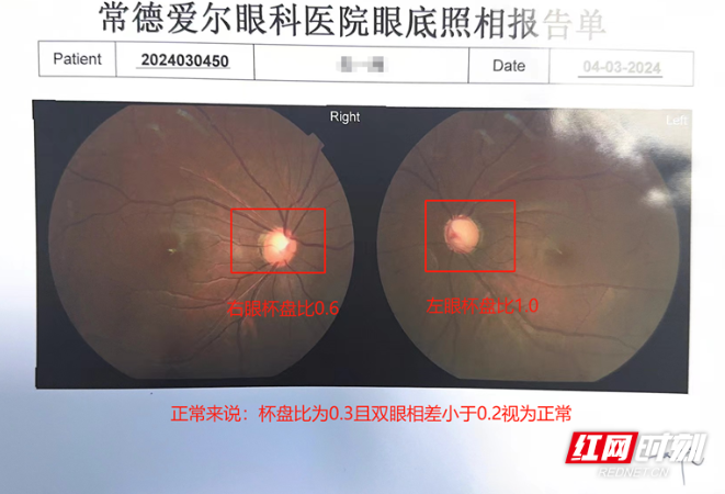 17岁少年戴眼镜也看不清，一查竟是青光眼晚期！