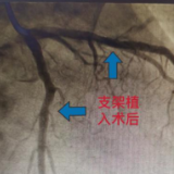 临澧县中医医院心血管内科为八旬老太成功实施冠脉支架植入术