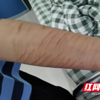 心理专家支招应对青少年非自杀性自伤行为