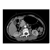 郴州市第四人民医院：破解不明原因重度贫血 内镜微创取出胃窦 “隐形杀手”