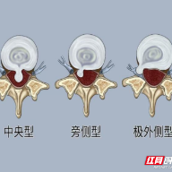 郴州市第一人民医院：一个1.8厘米的小切口如何逆转困局