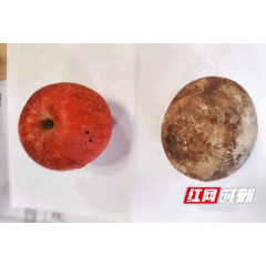 结石比苹果大！湘雅常德医院成功为患者取出巨大膀胱结石