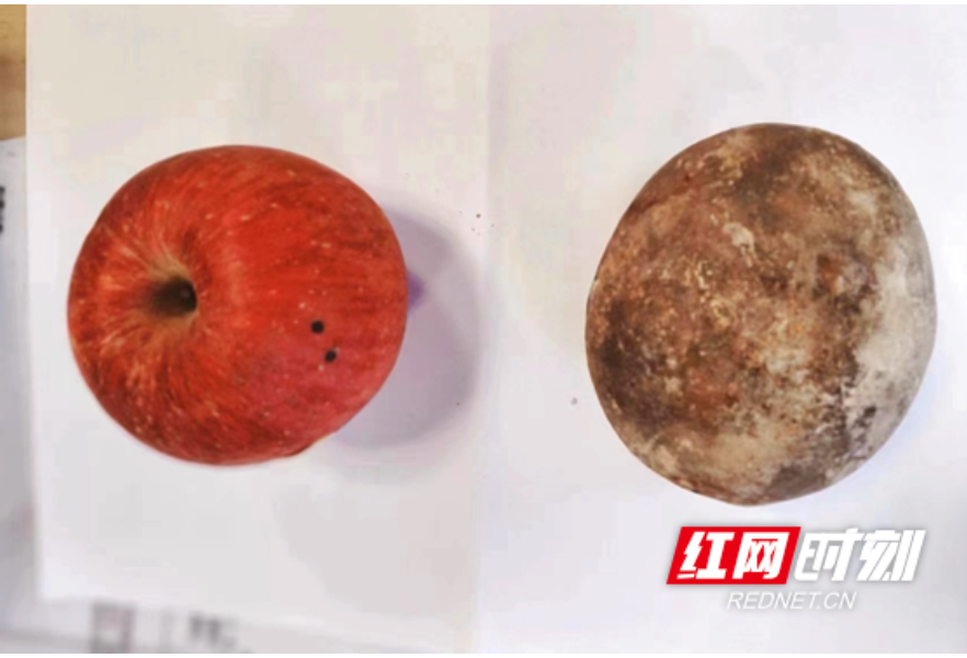 结石比苹果大！湘雅常德医院成功为患者取出巨大膀胱结石