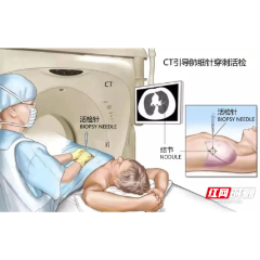 常德市第一中医医院：肺部出现结节？穿刺活检还你“针”相大白