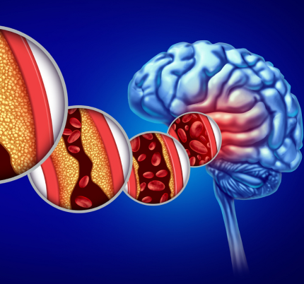 男子睡觉时突发脑出血,多学科协作拉响“生命保卫战”
