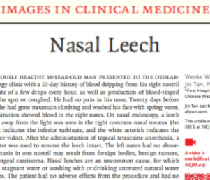 首登国际医学期刊！湖南中医附一专家揭秘罕见鼻出血病因