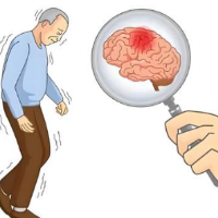 国家卫健委提醒：这些认知误区潜藏严重卒中风险