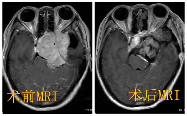患者术前、术后头部MRI检查图像.jpg