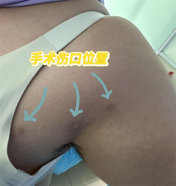 手术位置.png