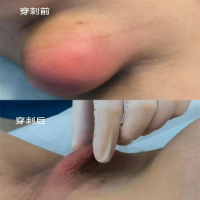 腋下惊现“红桃”胀痛难忍！产后妈妈副乳竟也“胀奶”了