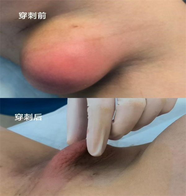 腋下惊现“红桃”胀痛.jpg