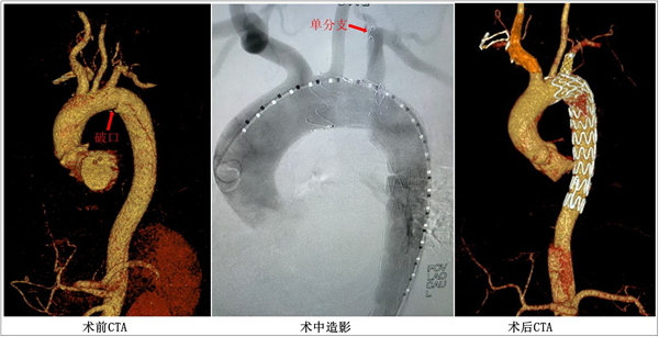 患者蔡先生主动脉CTA检查情况.png 患者蔡先生主动脉CTA检查情况.png