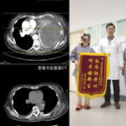 湘雅医院胸外科切除罕见巨大胸腔肿瘤，多学科协作让患者重获自由呼吸
