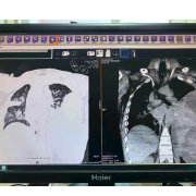 76天生死营救：湘雅医院成功救治重症肺炎合并脓毒性休克患者