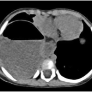 1岁宝宝胃竟“跑”进胸腔 微创手术助其复位
