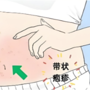 预防带状疱疹，3类高风险人群需警惕